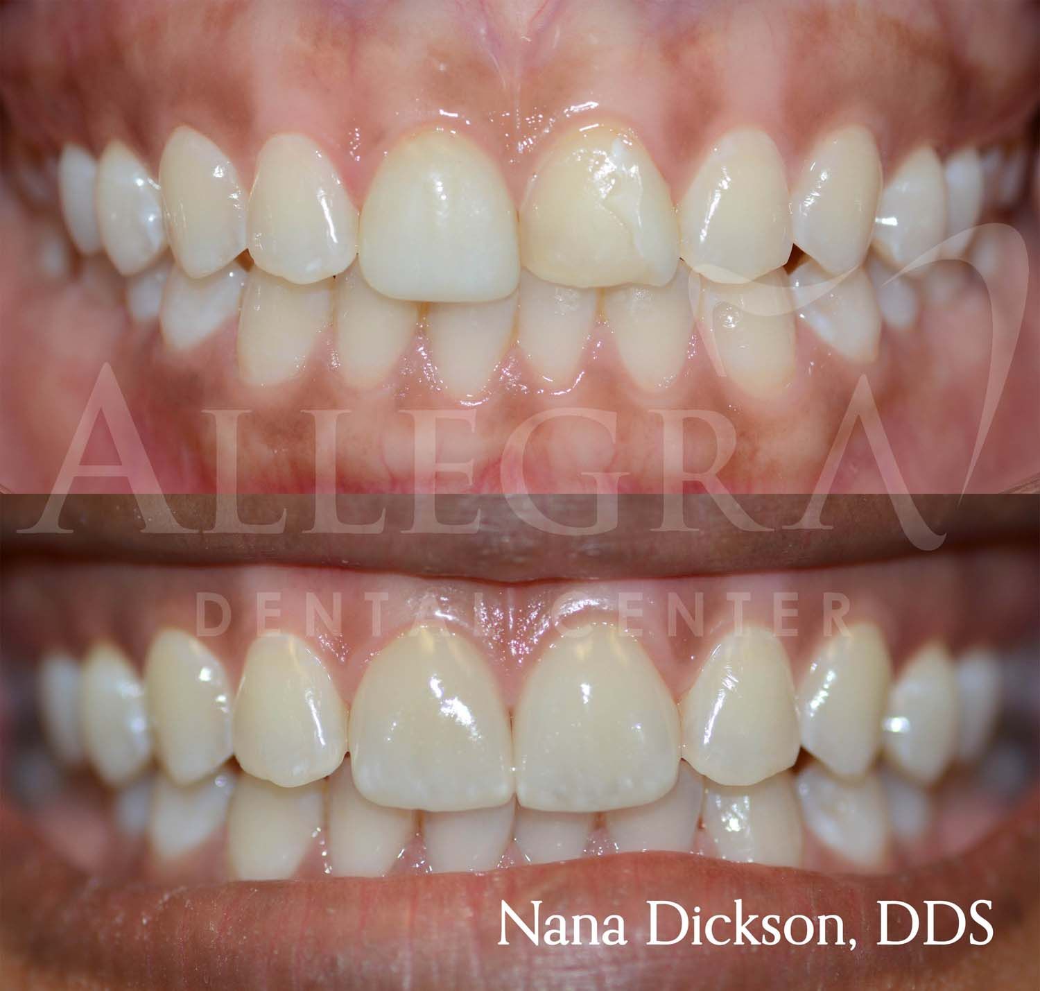 Veneers Before and After case 32 from Allegra Dental Center