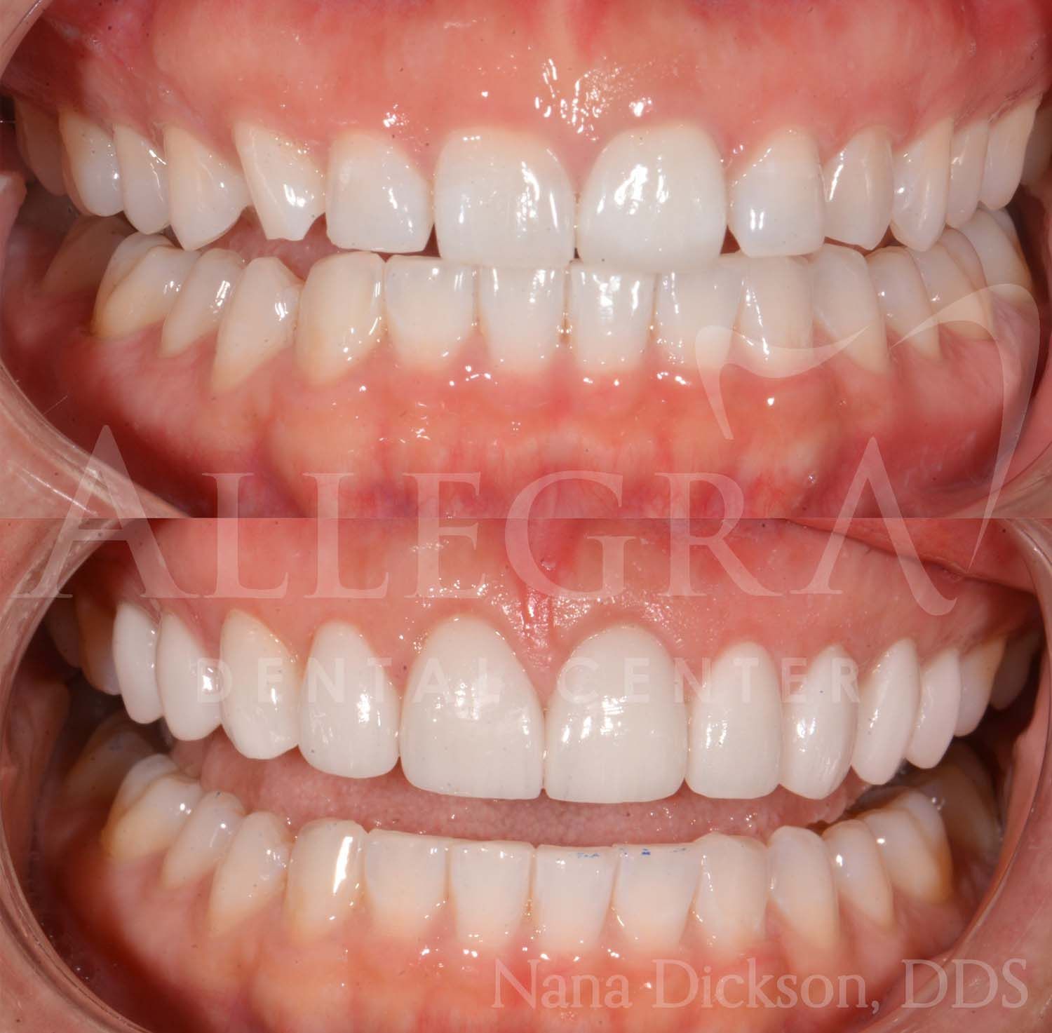 Veneers Before and After case 33 from Allegra Dental Center