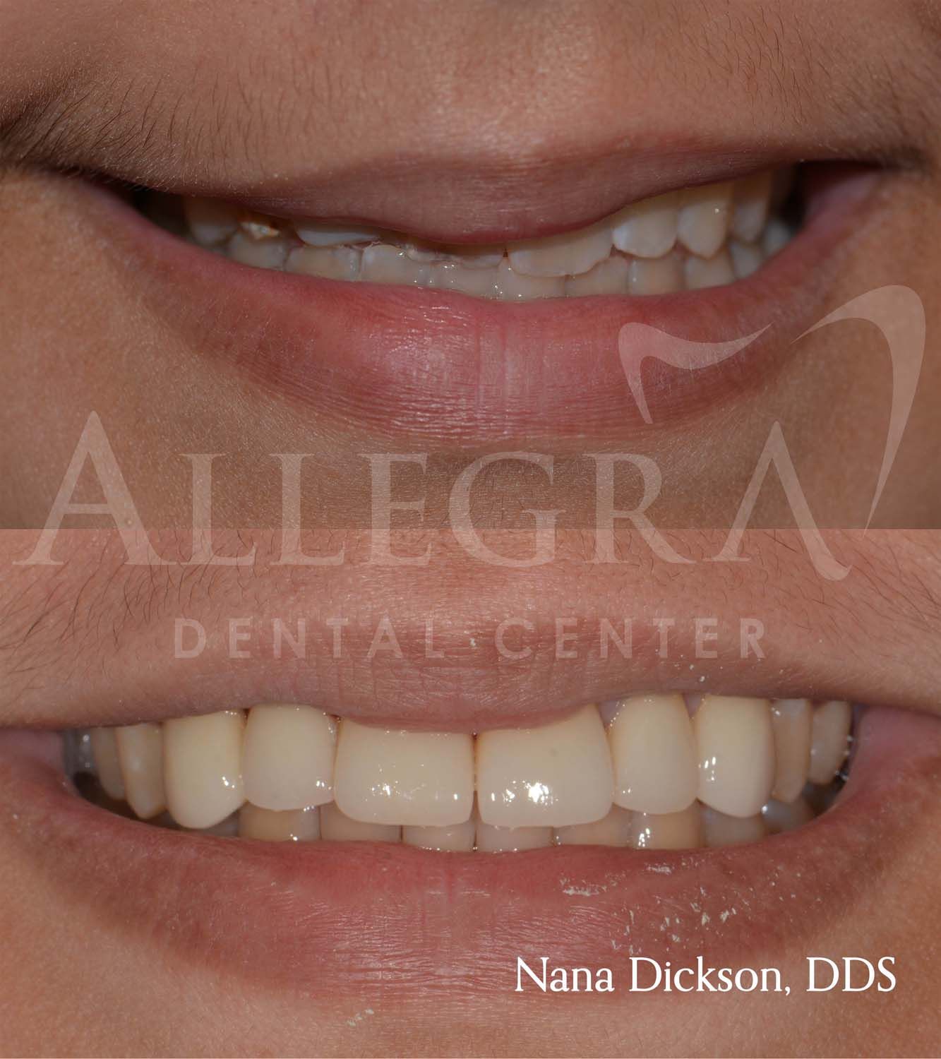 Veneers Before and After case 34 from Allegra Dental Center