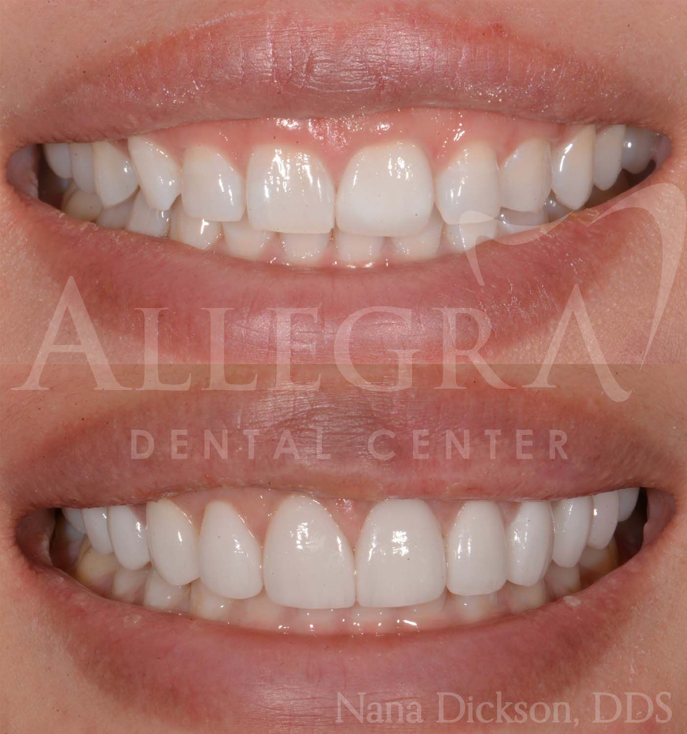 Veneers Before and After case 35 from Allegra Dental Center