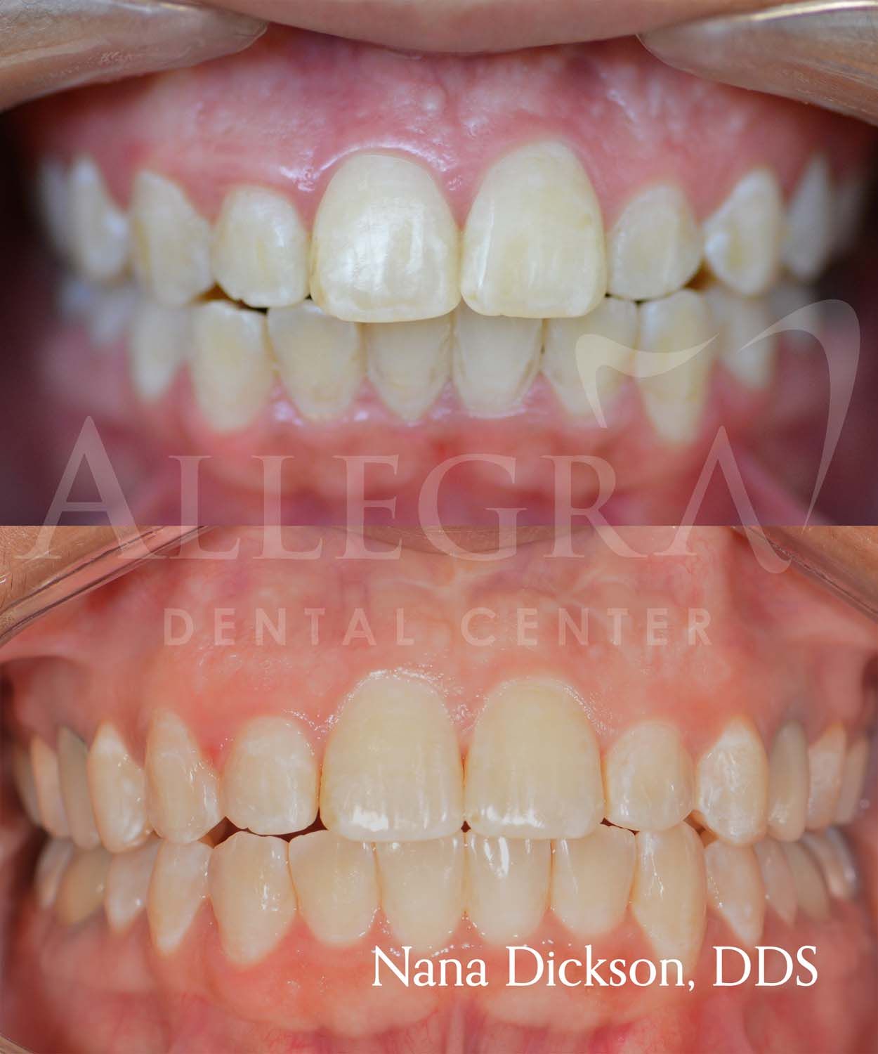 Veneers Before and After case 36 from Allegra Dental Center