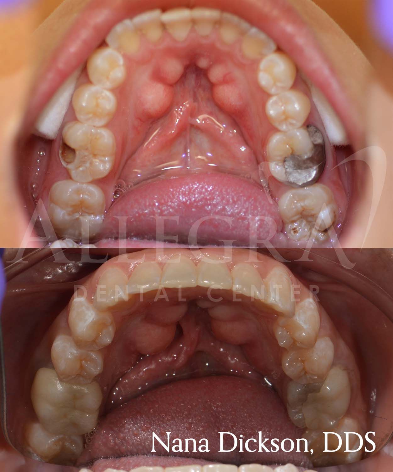 Veneers Before and After case 37 from Allegra Dental Center