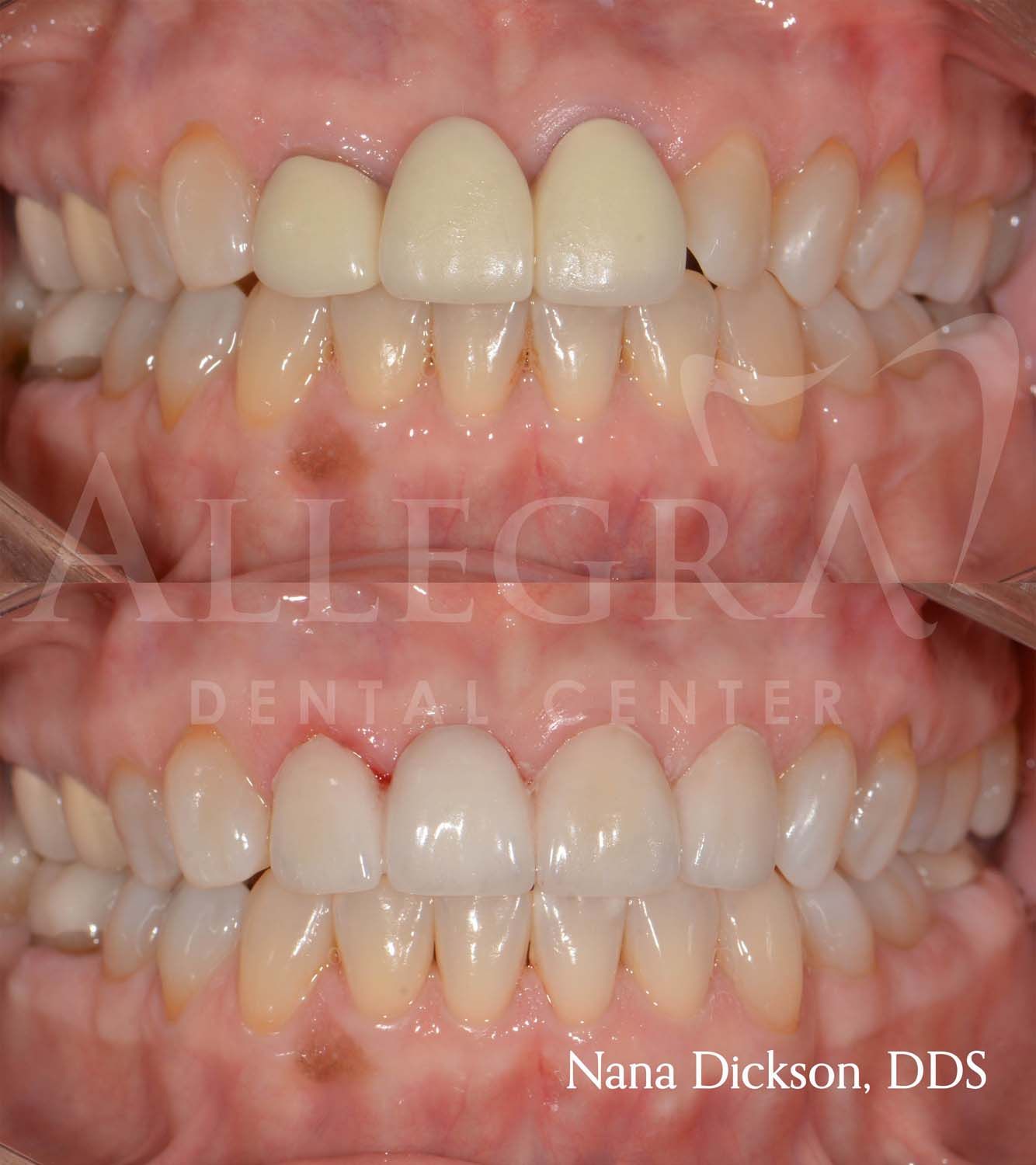 Veneers Before and After case 39 from Allegra Dental Center