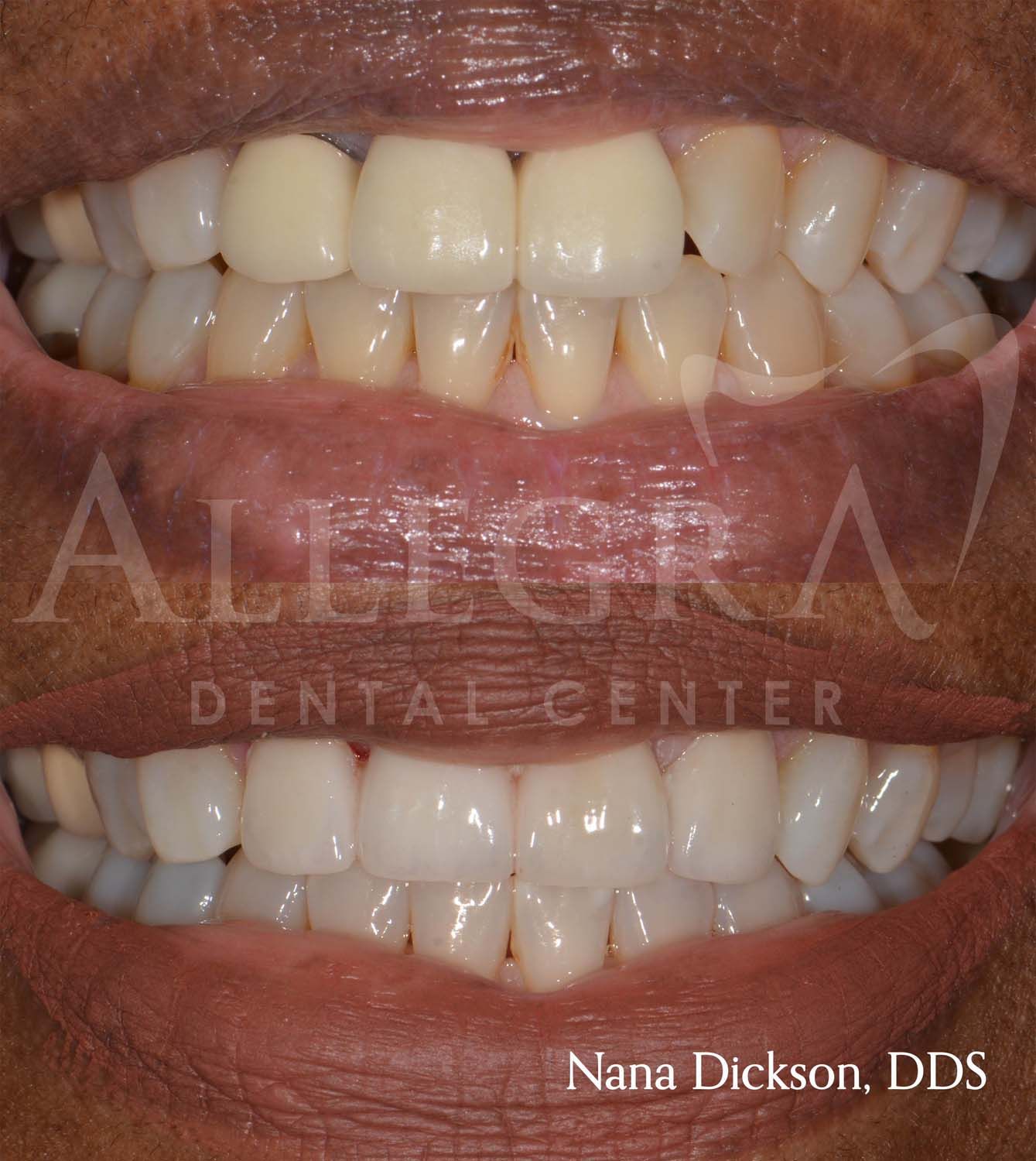 Veneers Before and After case 40 from Allegra Dental Center