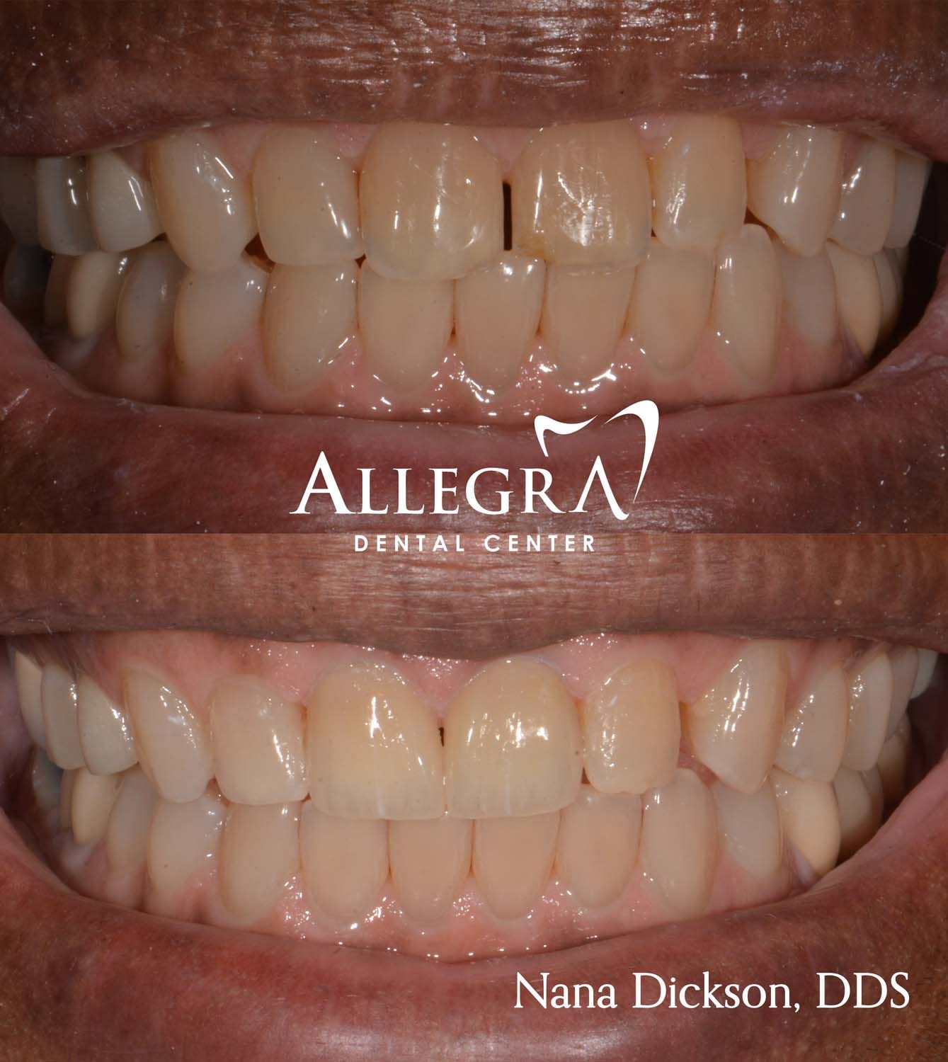 Veneers Before and After case 41 from Allegra Dental Center