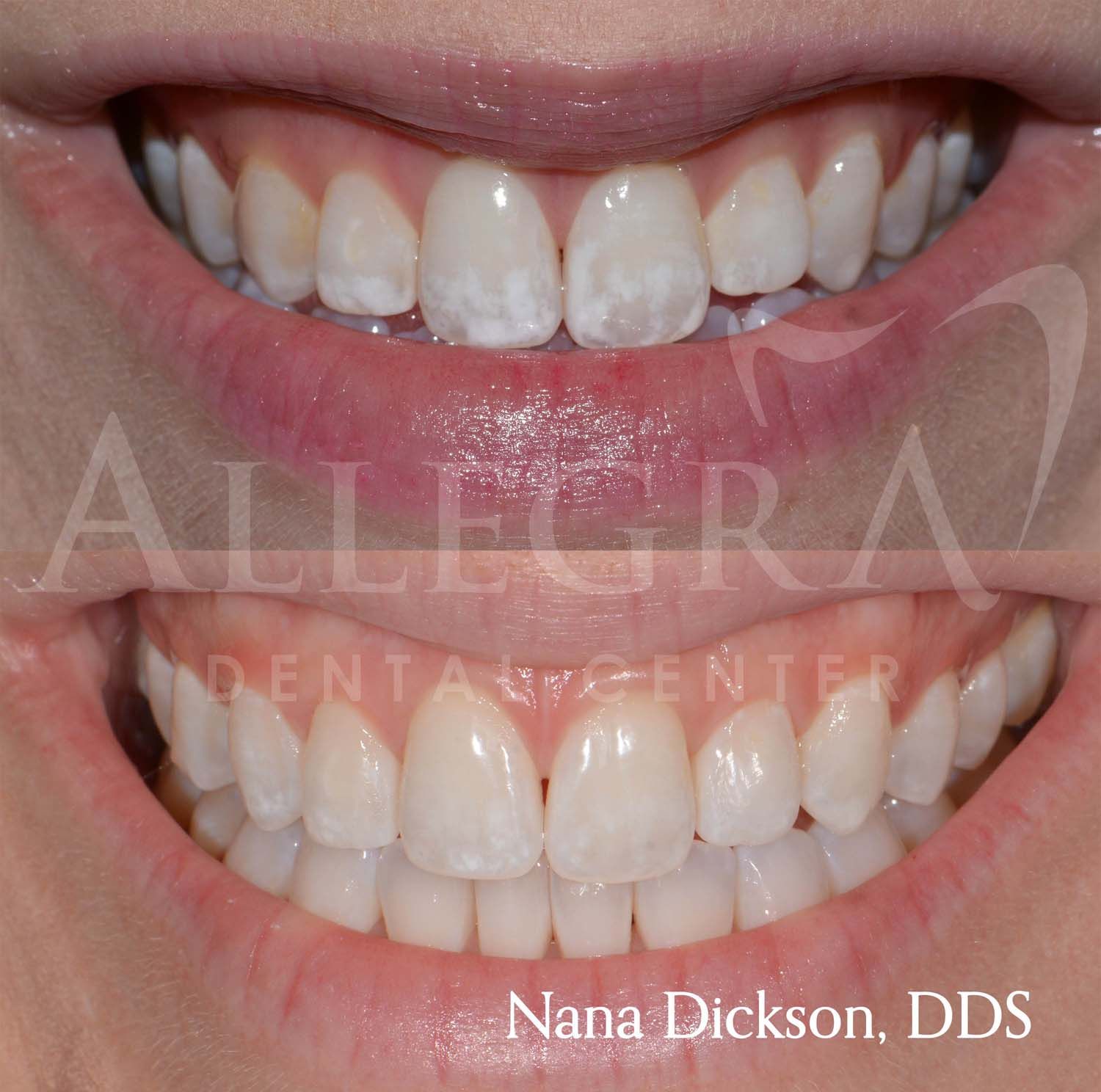 Veneers Before and After case 42 from Allegra Dental Center