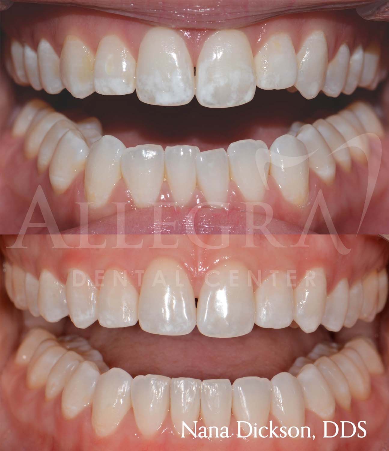 Veneers Before and After case 43 from Allegra Dental Center