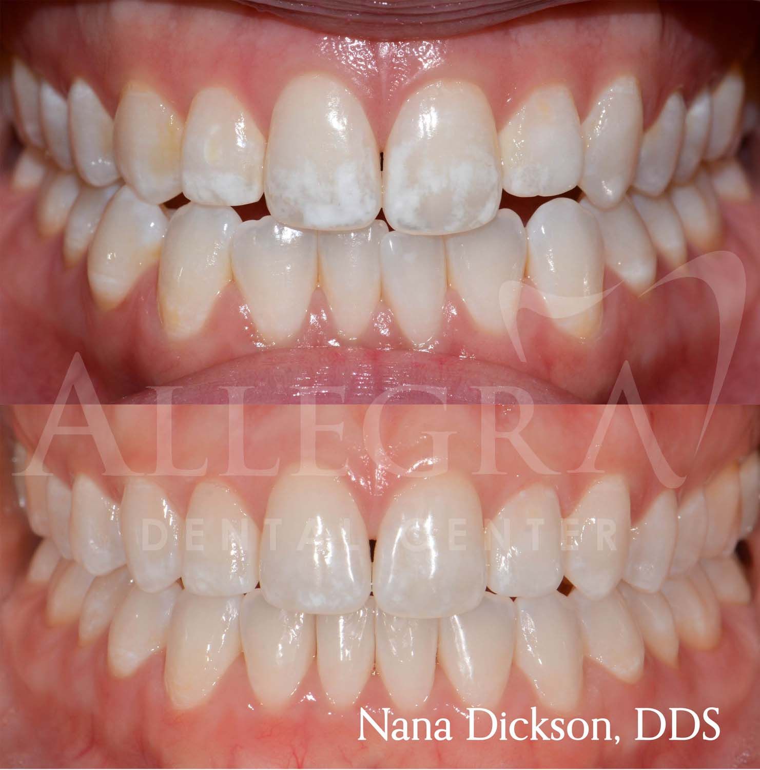 Veneers Before and After case 44 from Allegra Dental Center