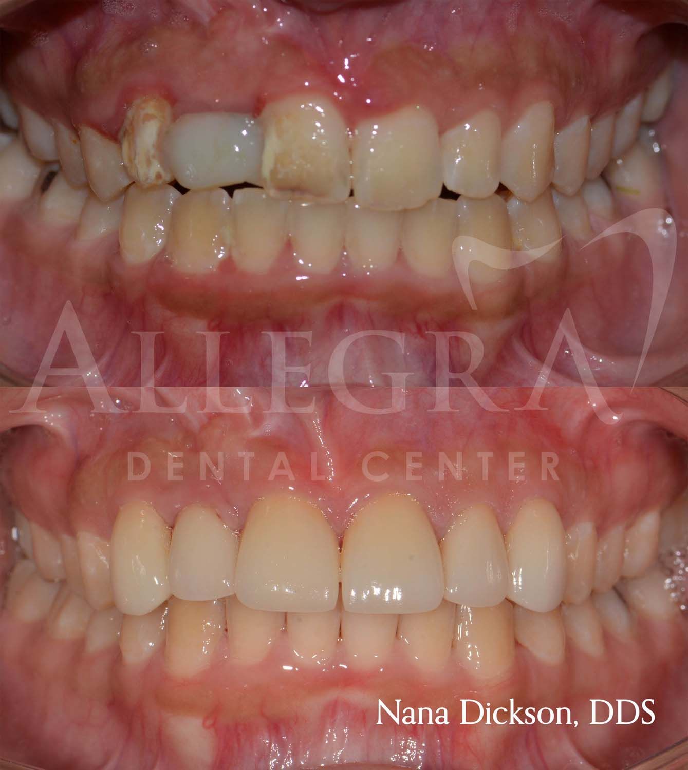 Veneers Before and After case 45 from Allegra Dental Center