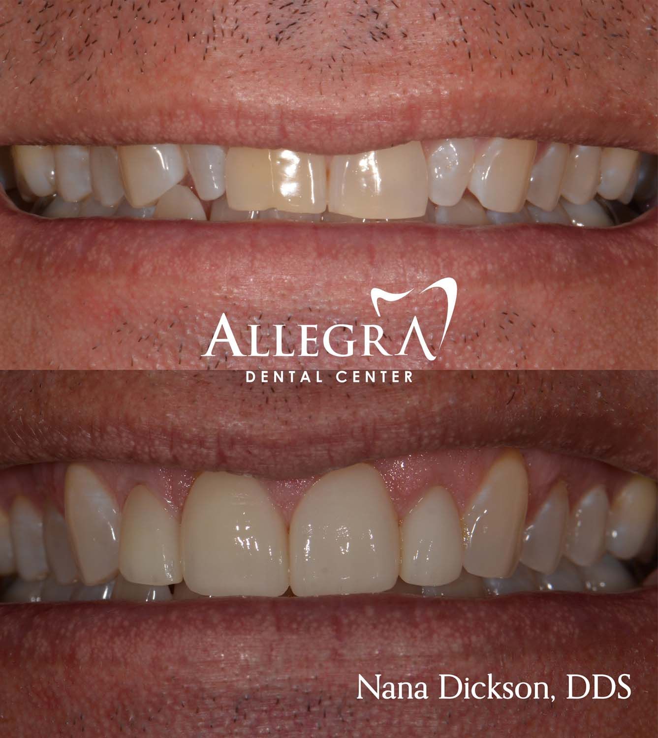 Veneers Before and After case 46 from Allegra Dental Center