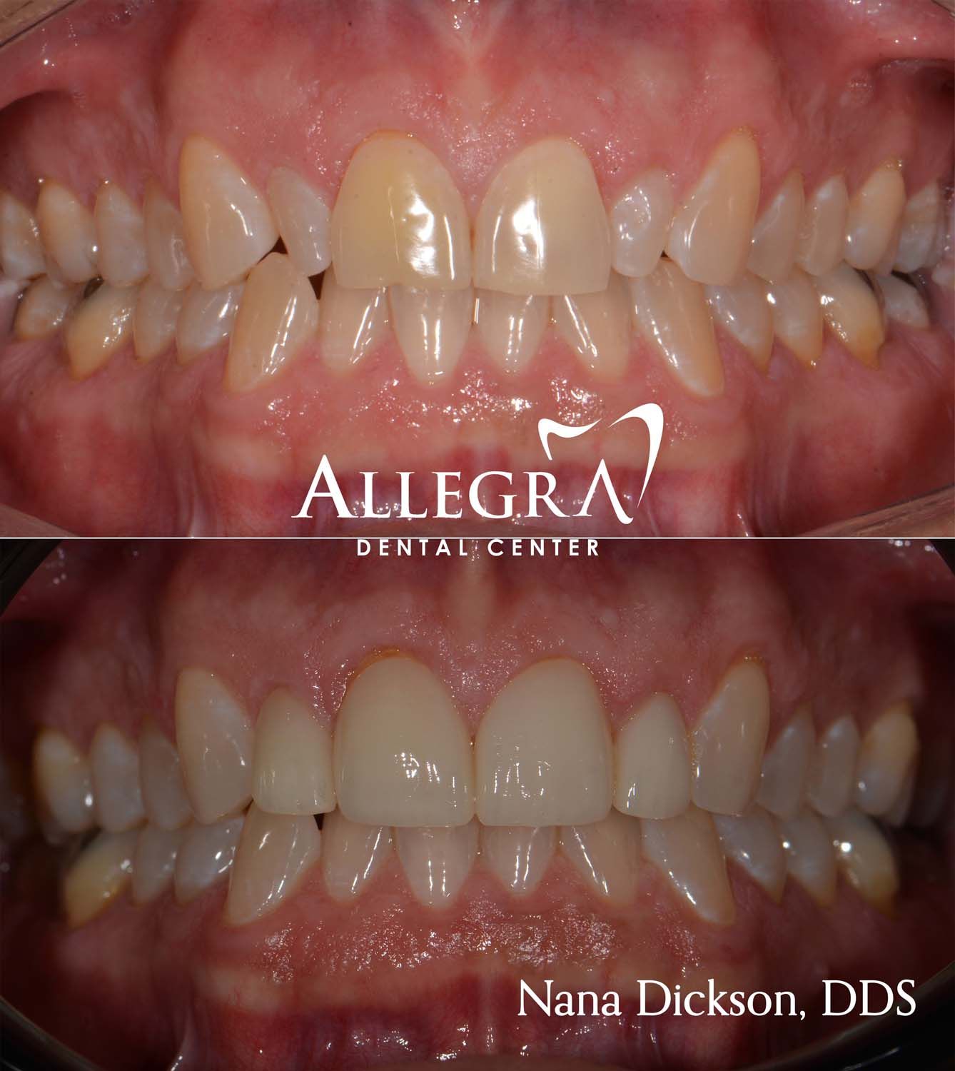 Veneers Before and After case 48 from Allegra Dental Center