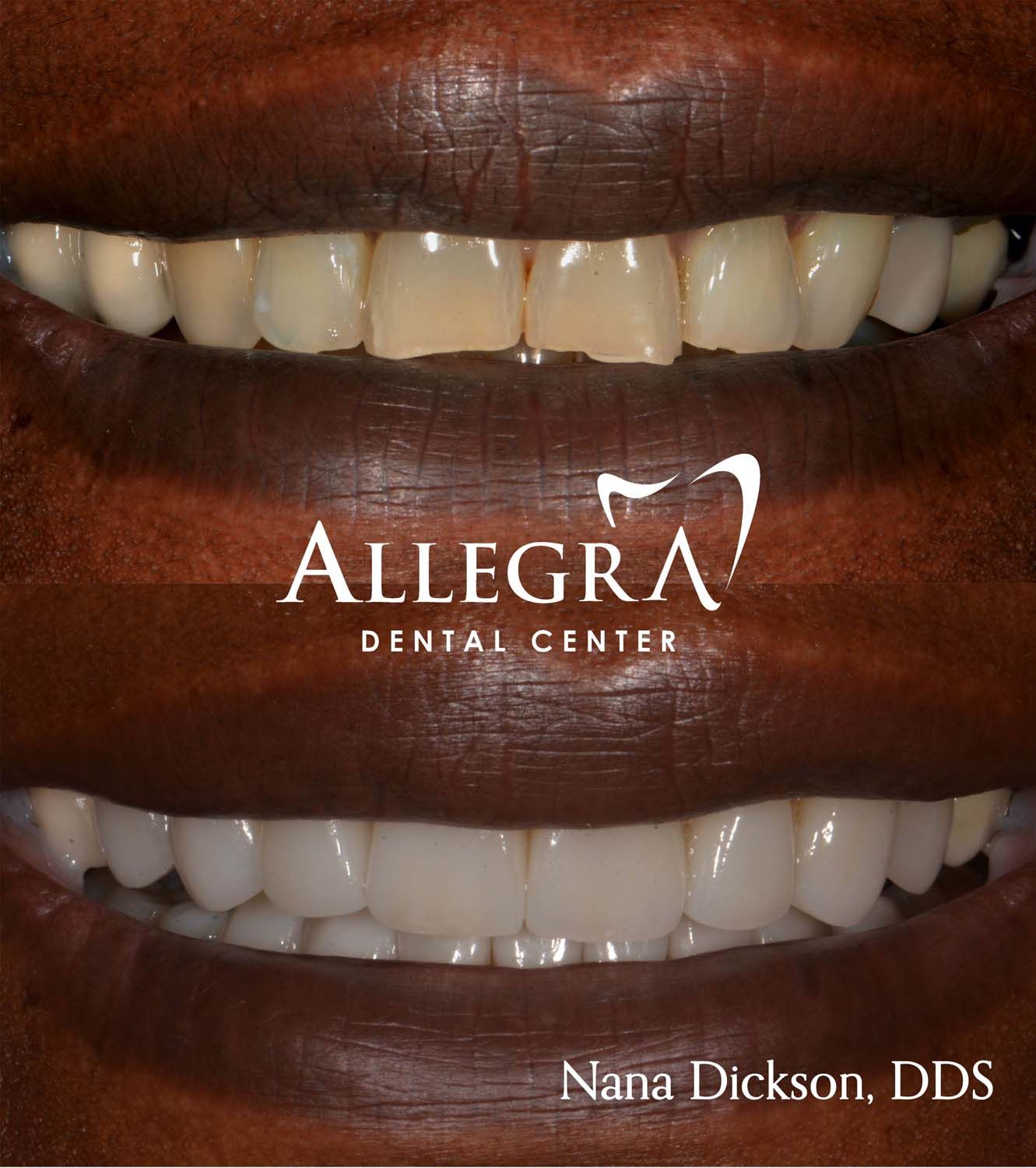 Veneers Before and After case 49 from Allegra Dental Center