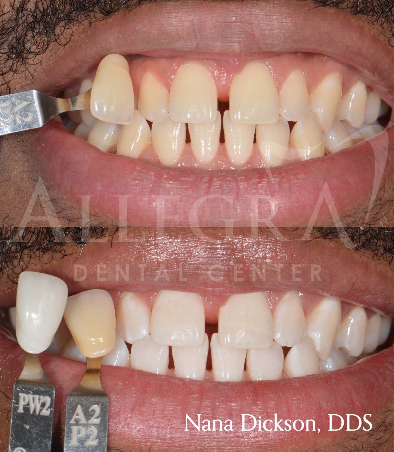 Veneers Before and After case 50 from Allegra Dental Center