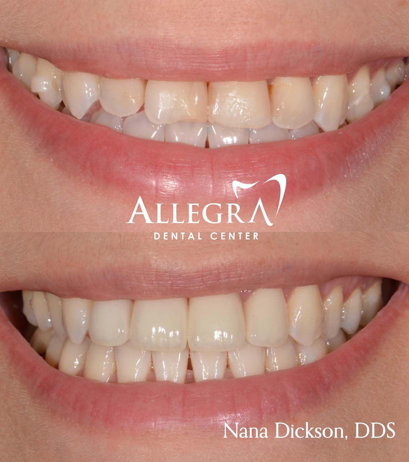 Veneers Before and After case 51 from Allegra Dental Center