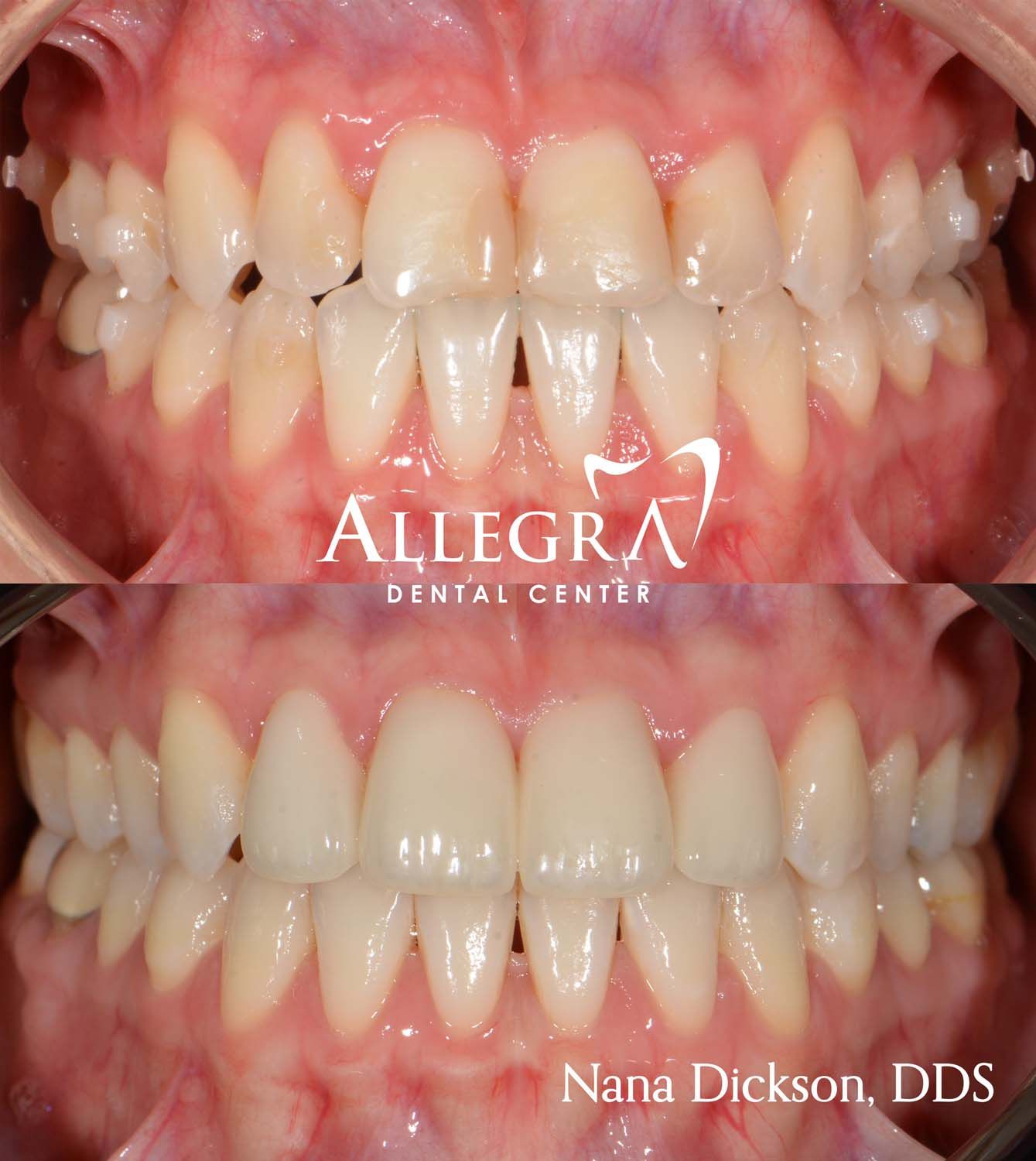Veneers Before and After case 52 from Allegra Dental Center