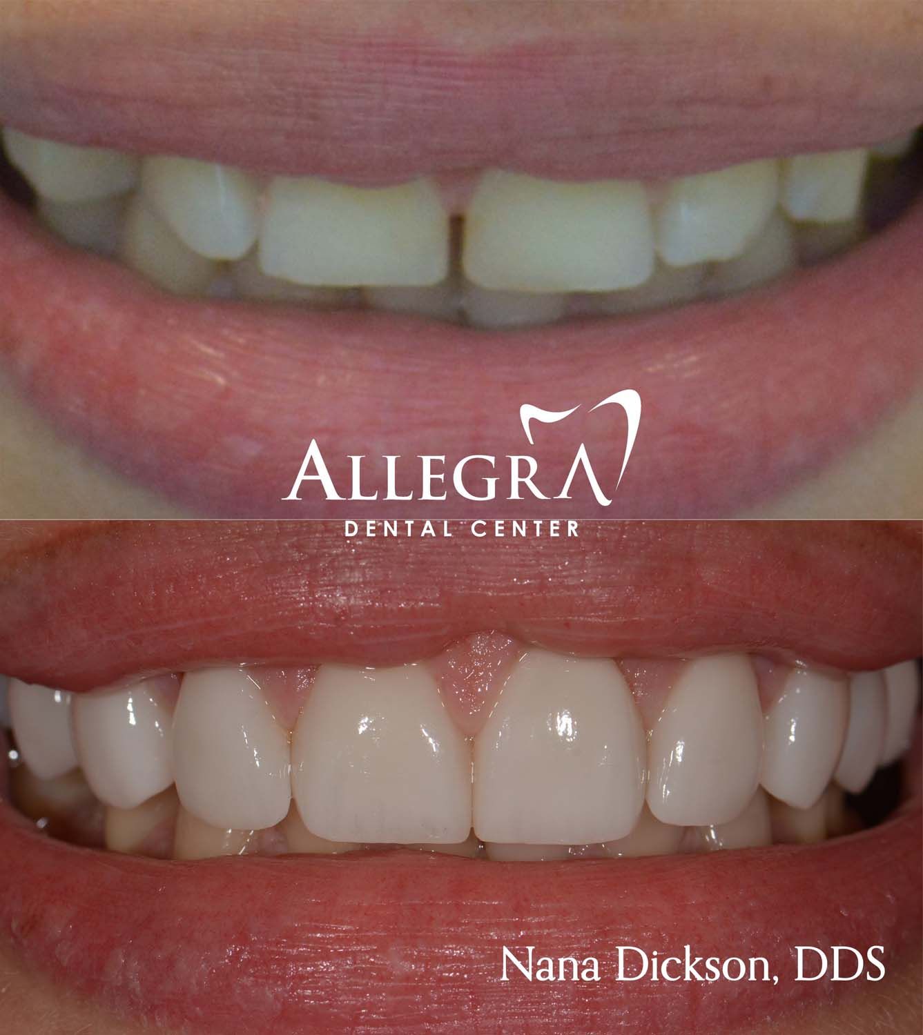 Veneers Before and After case 53 from Allegra Dental Center