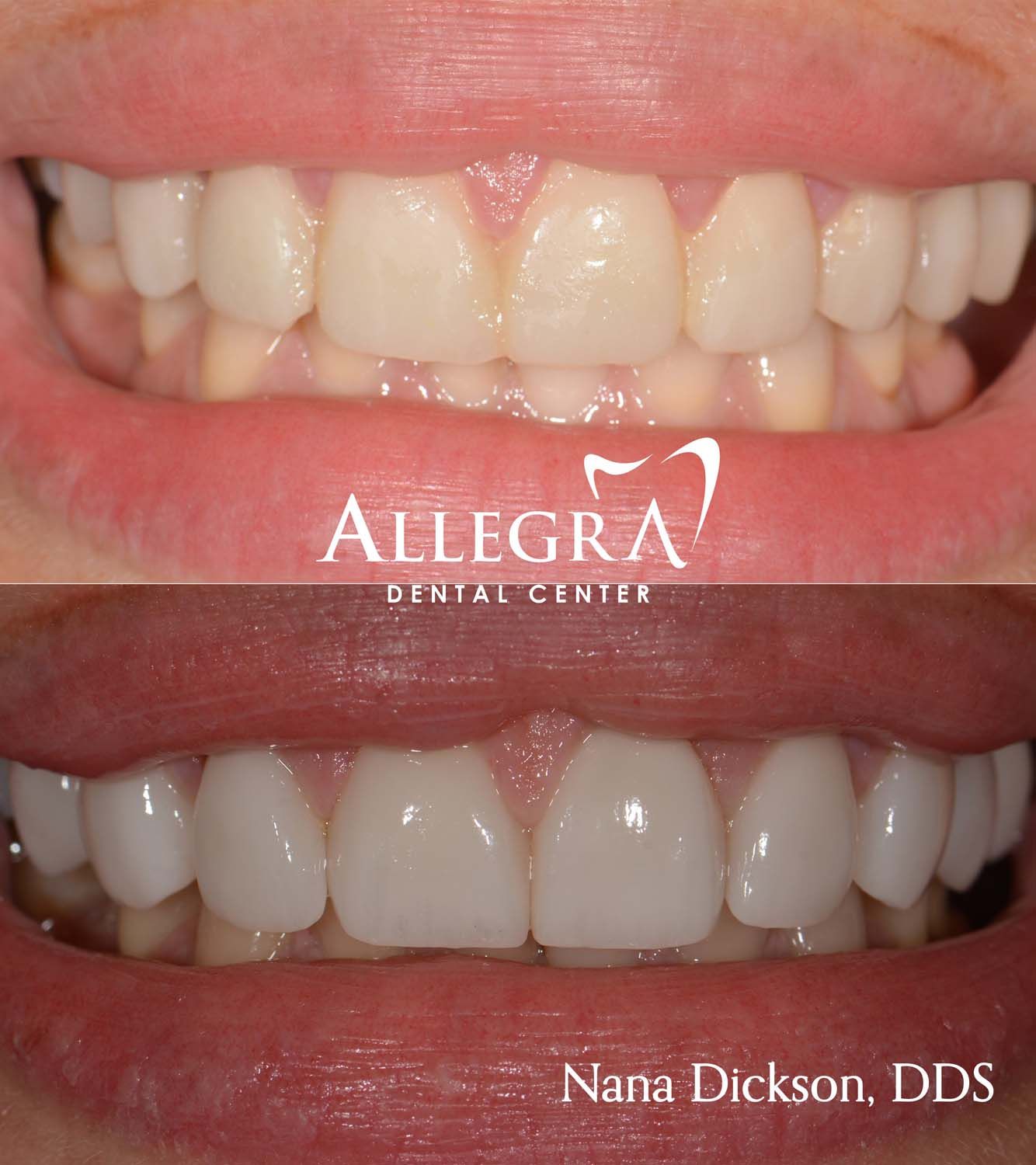 Veneers Before and After case 54 from Allegra Dental Center