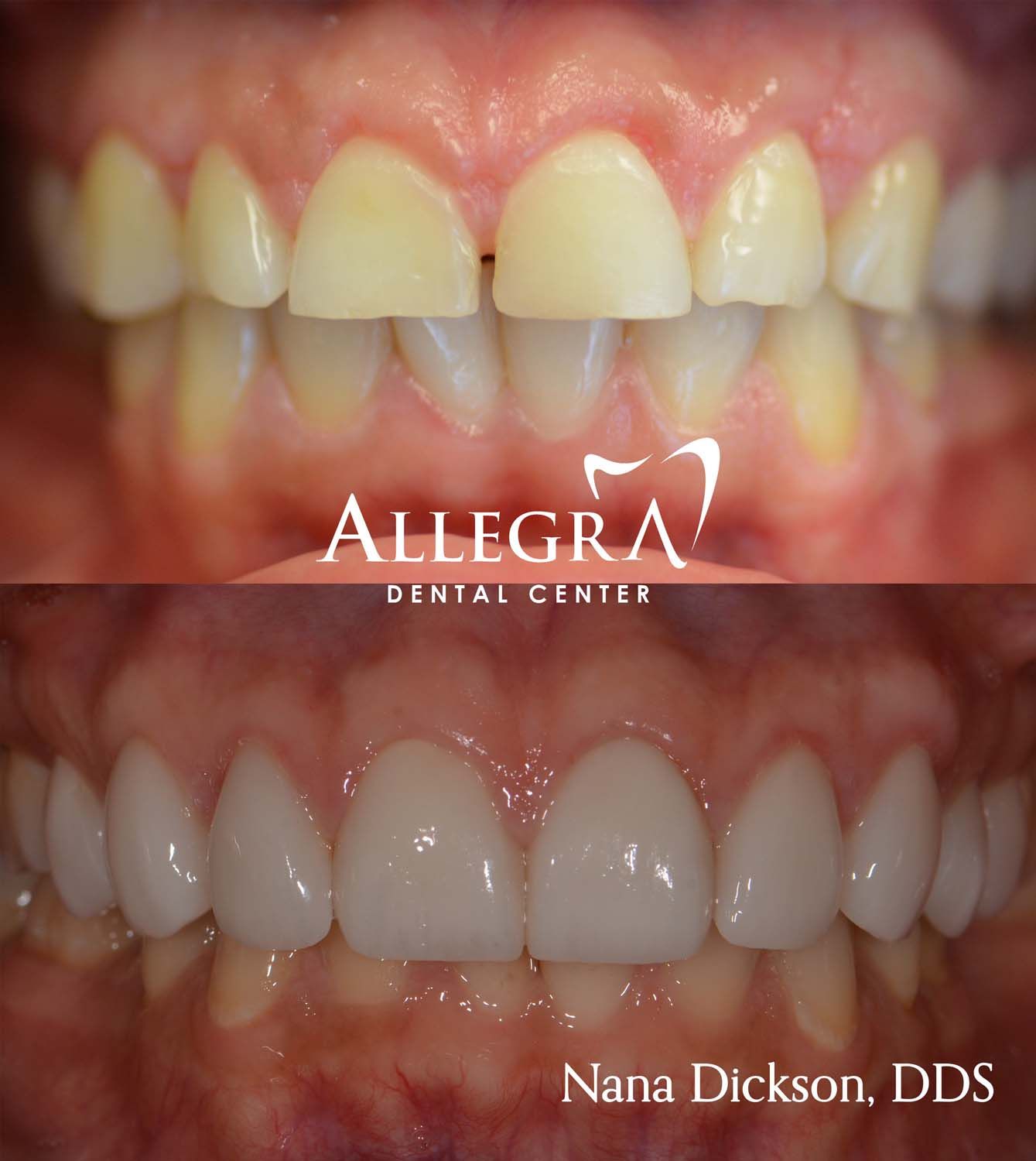 Veneers Before and After case 55 from Allegra Dental Center