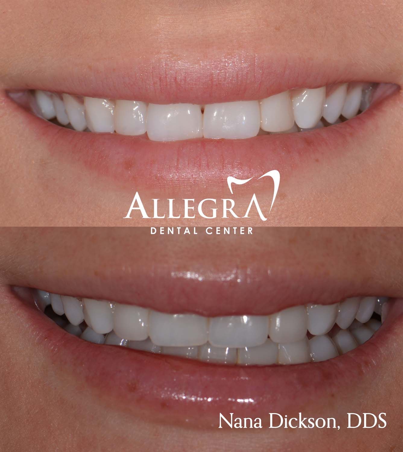 Veneers Before and After case 56 from Allegra Dental Center