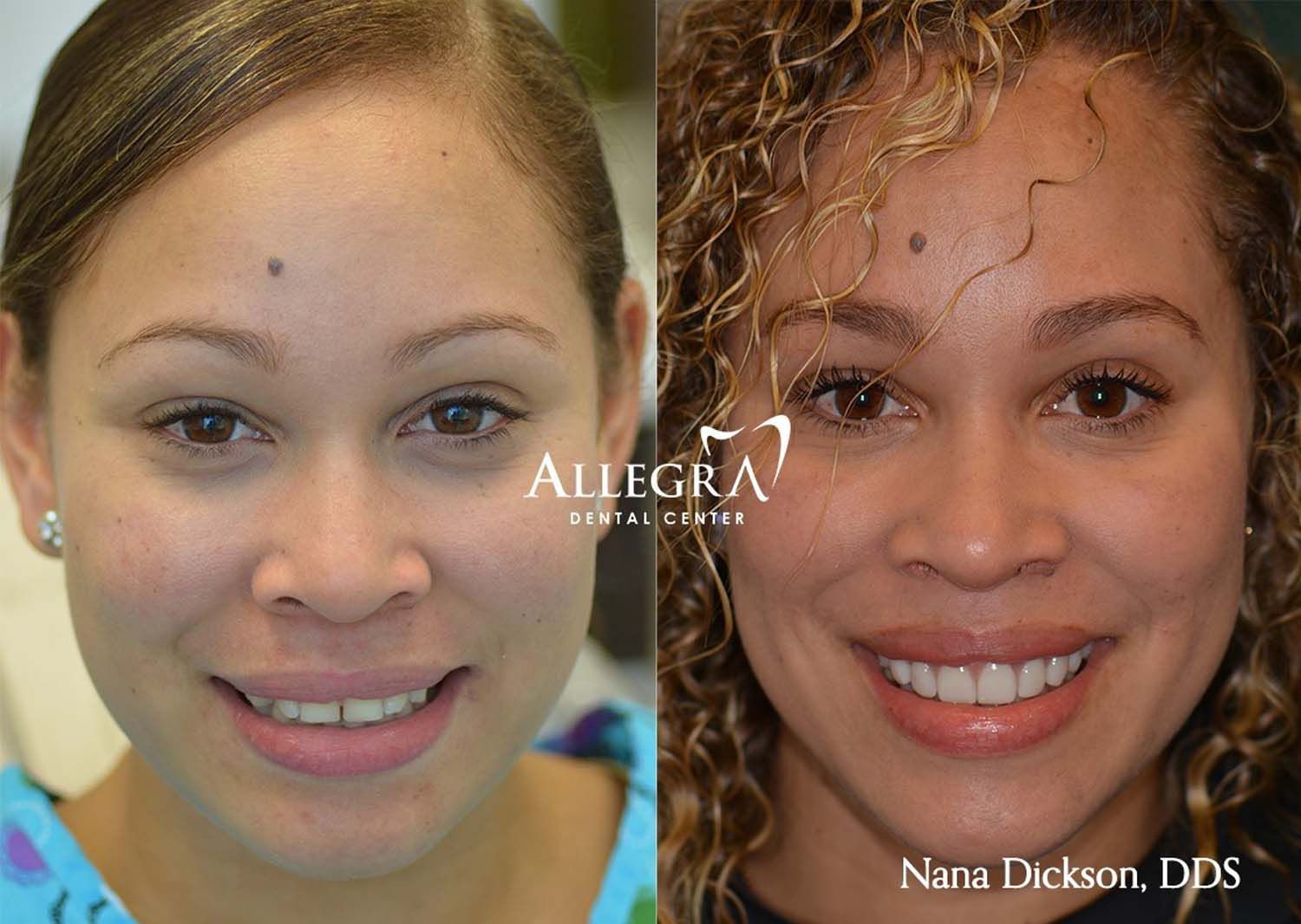 Veneers Before and After case 57 from Allegra Dental Center