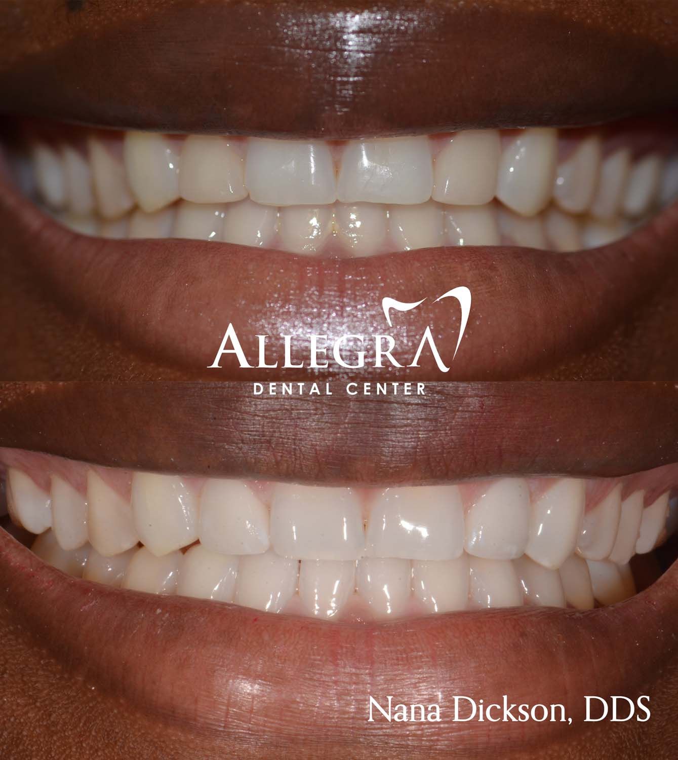 Veneers Before and After case 58 from Allegra Dental Center