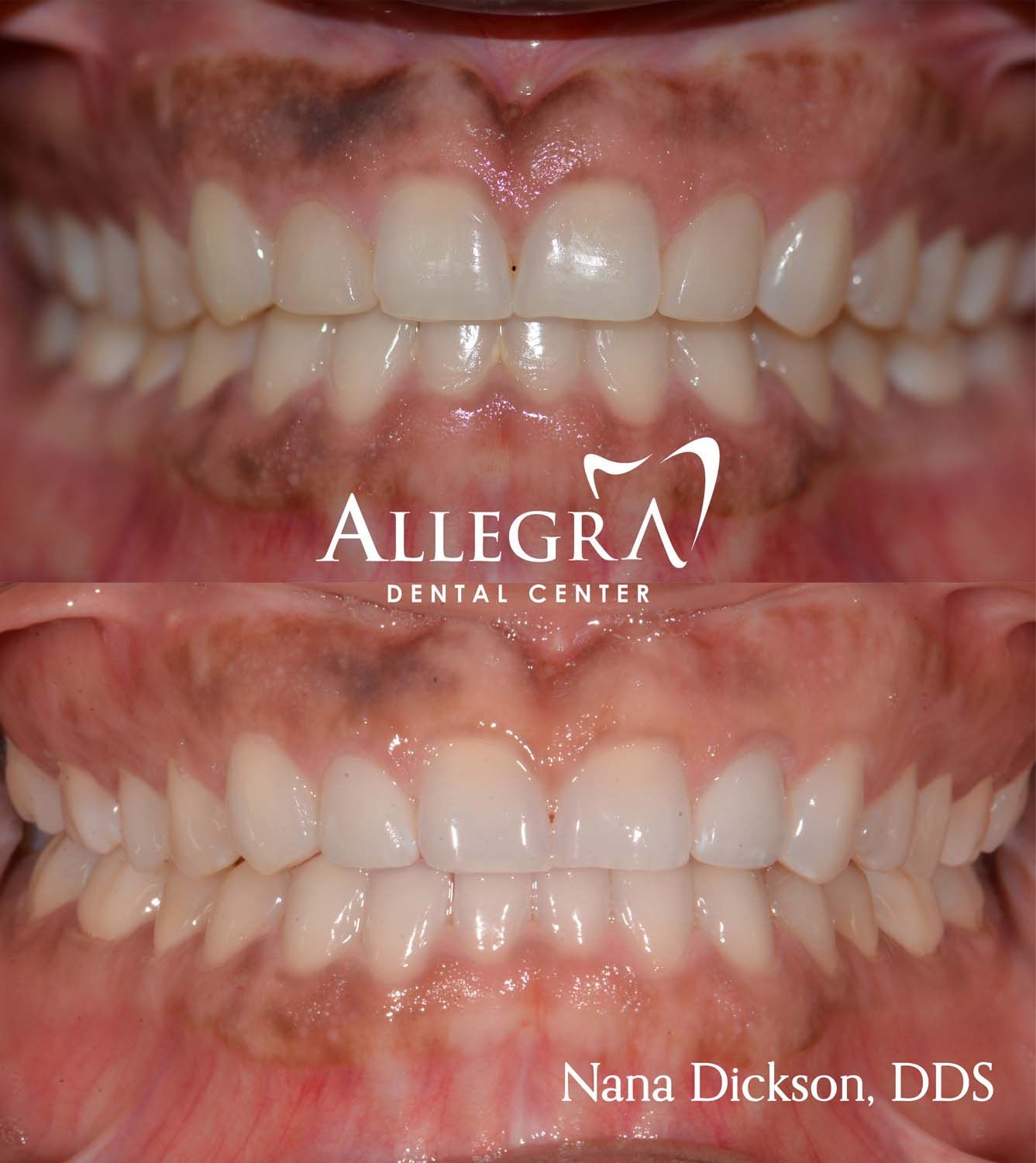 Veneers Before and After case 59 from Allegra Dental Center