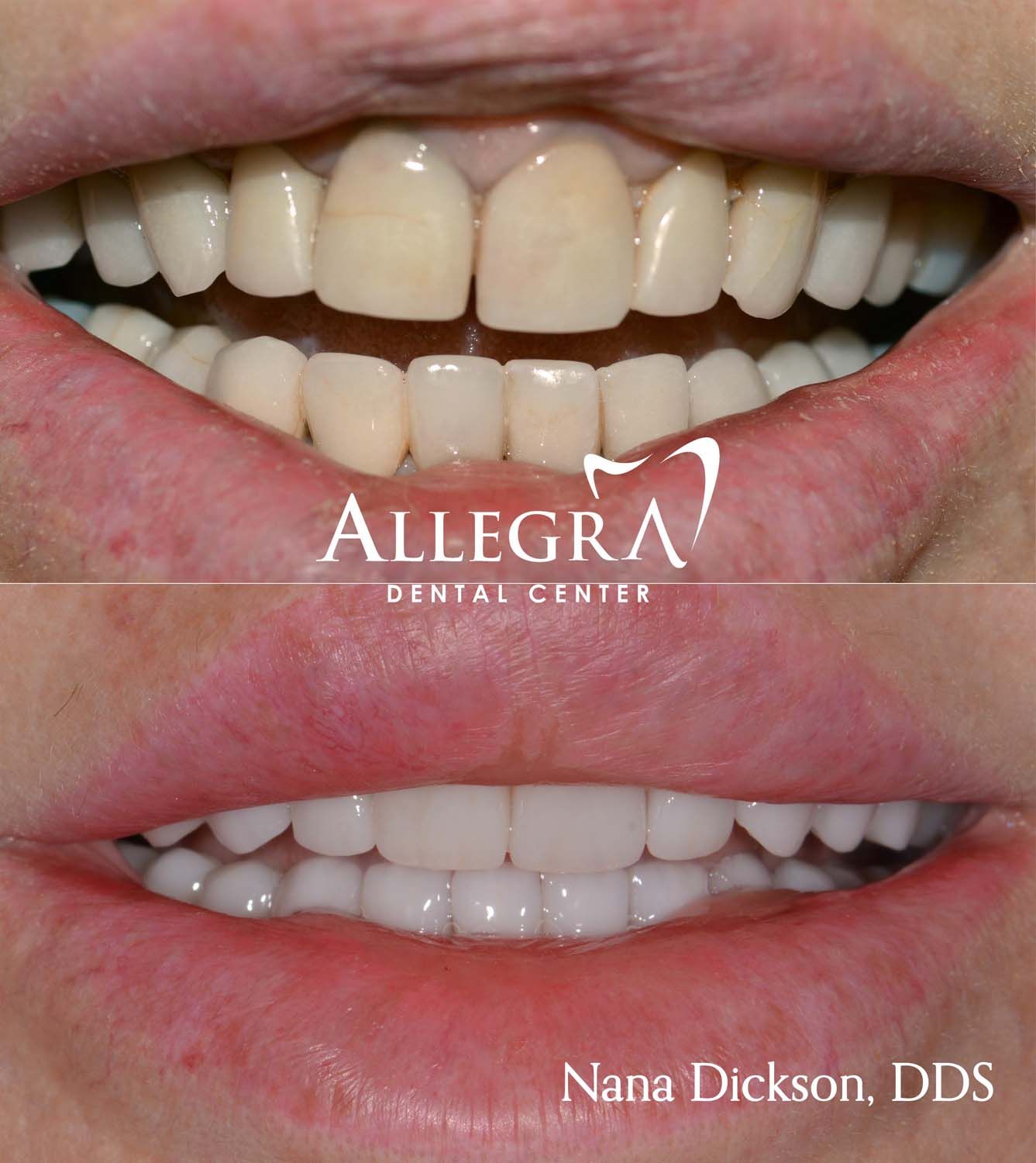 Veneers Before and After case 61 from Allegra Dental Center