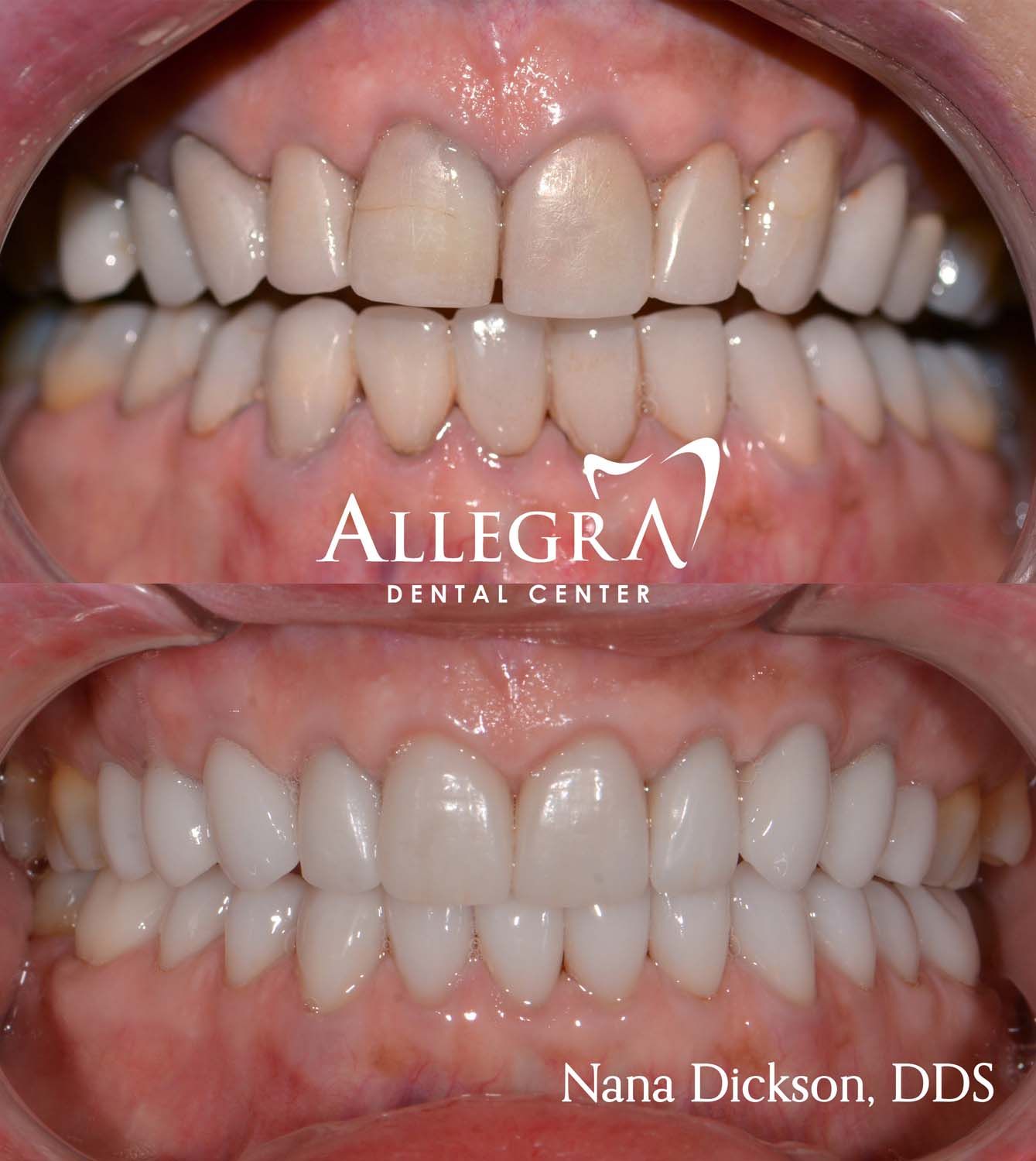 Veneers Before and After case 62 from Allegra Dental Center