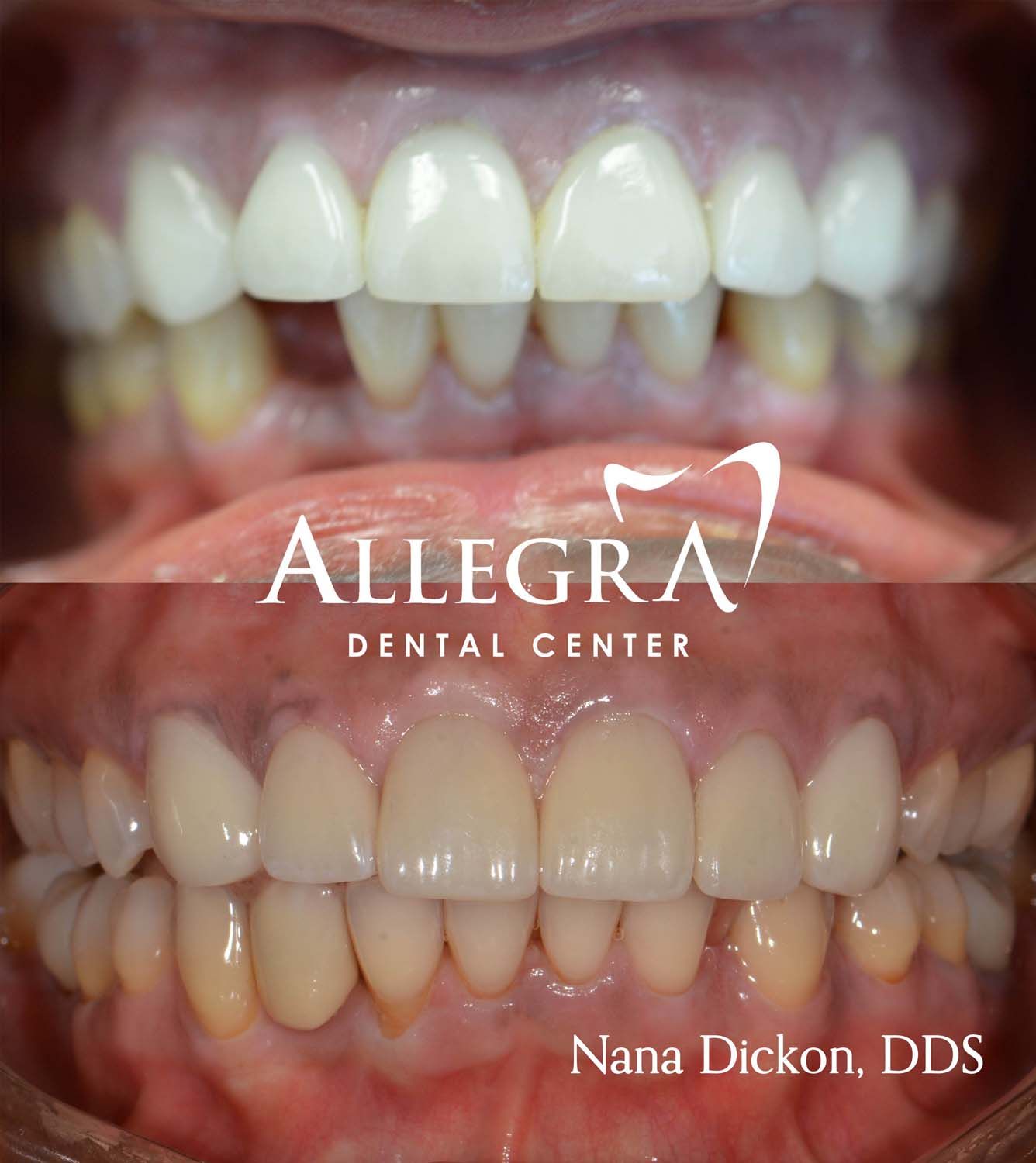 Veneers Before and After case 63 from Allegra Dental Center