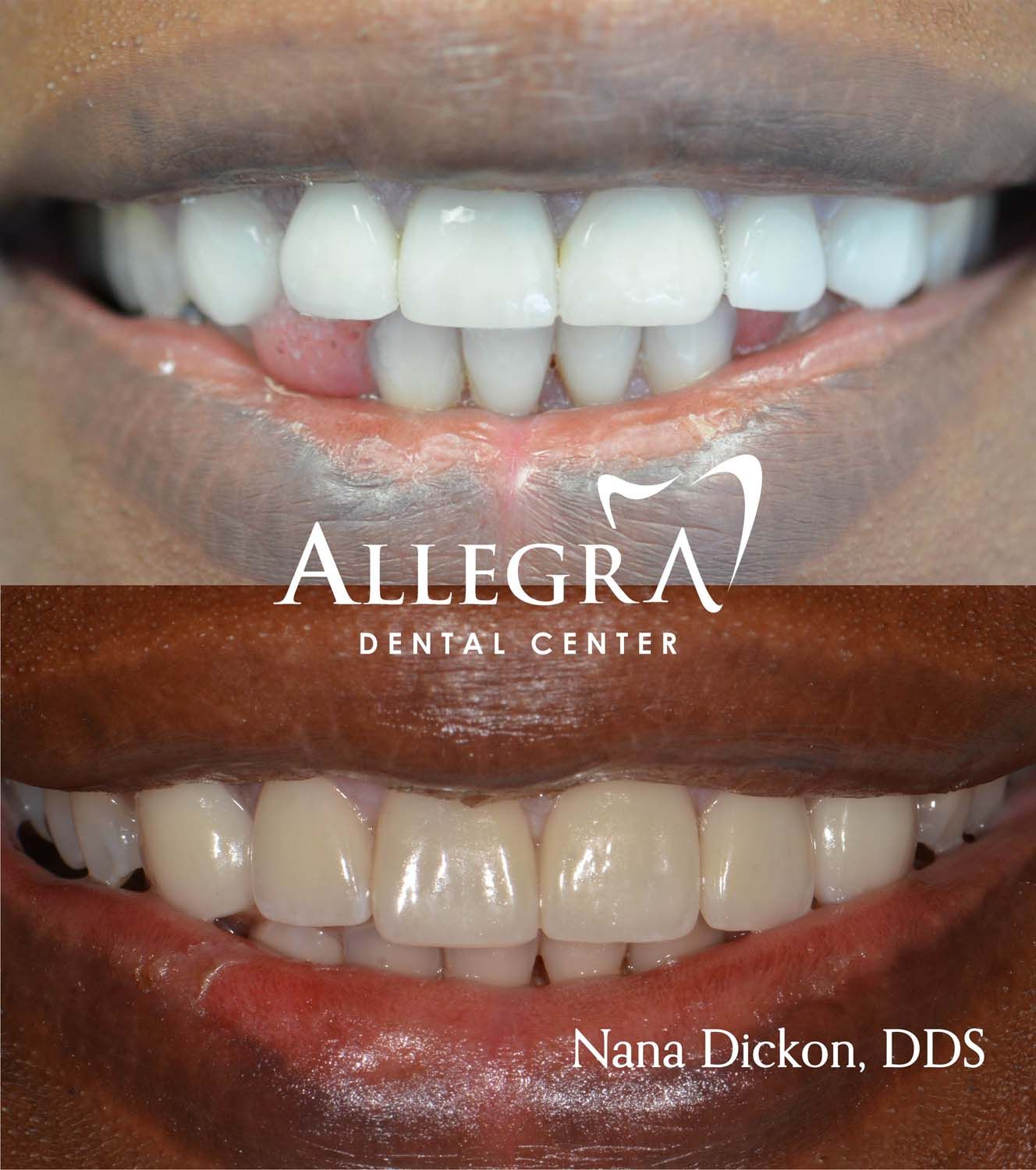Veneers Before and After case 64 from Allegra Dental Center