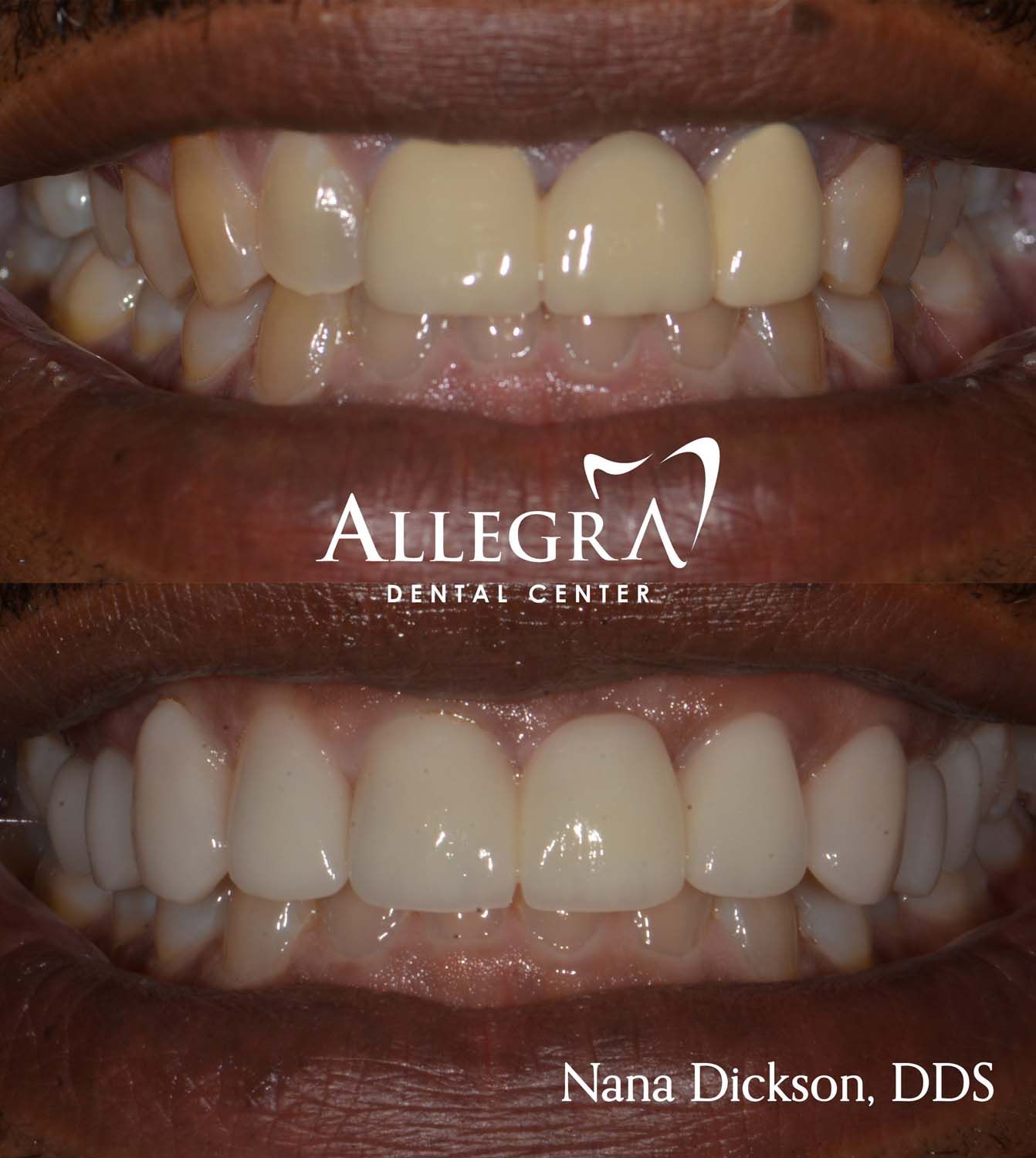 Veneers Before and After case 65 from Allegra Dental Center