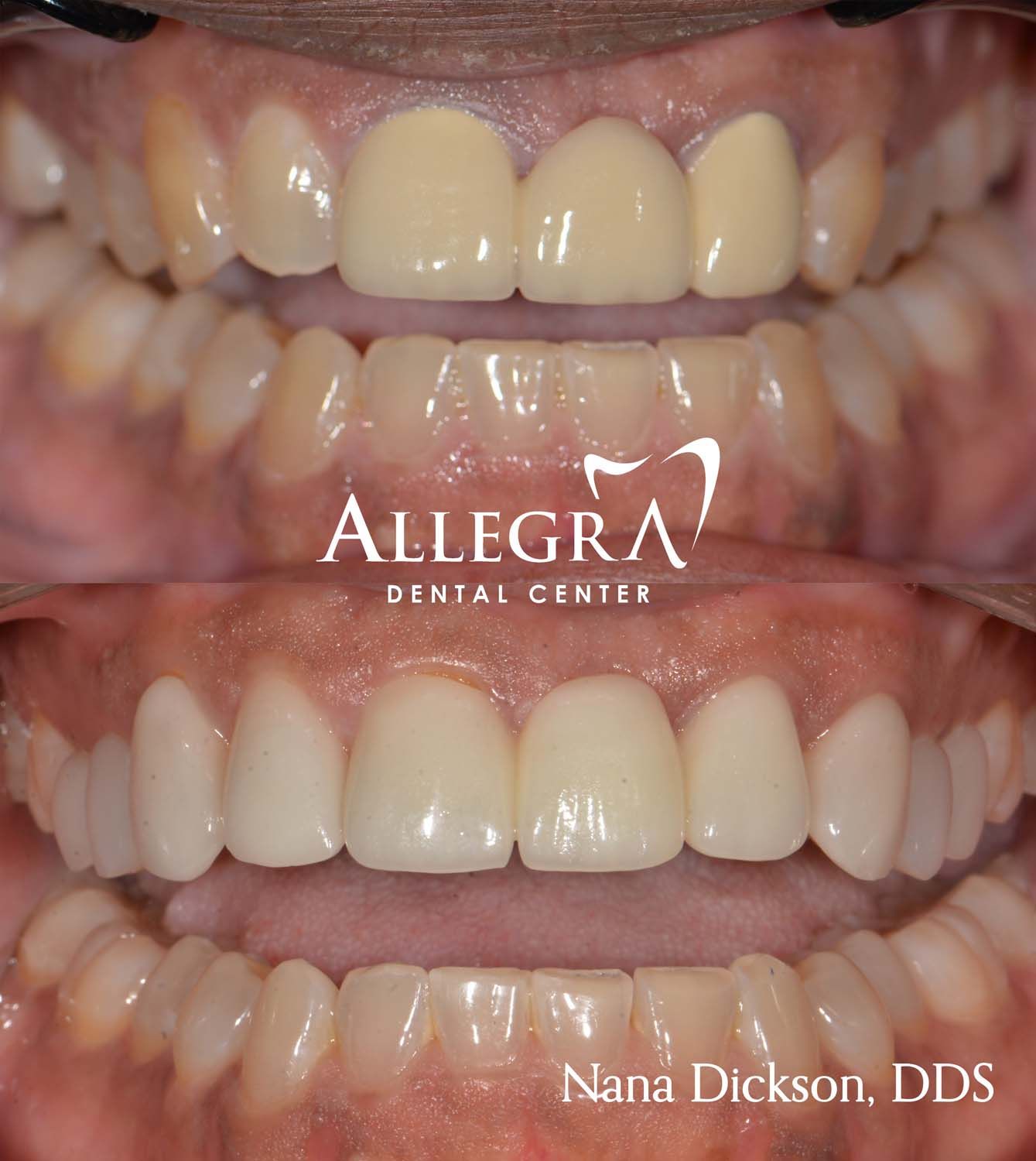 Veneers Before and After case 66 from Allegra Dental Center