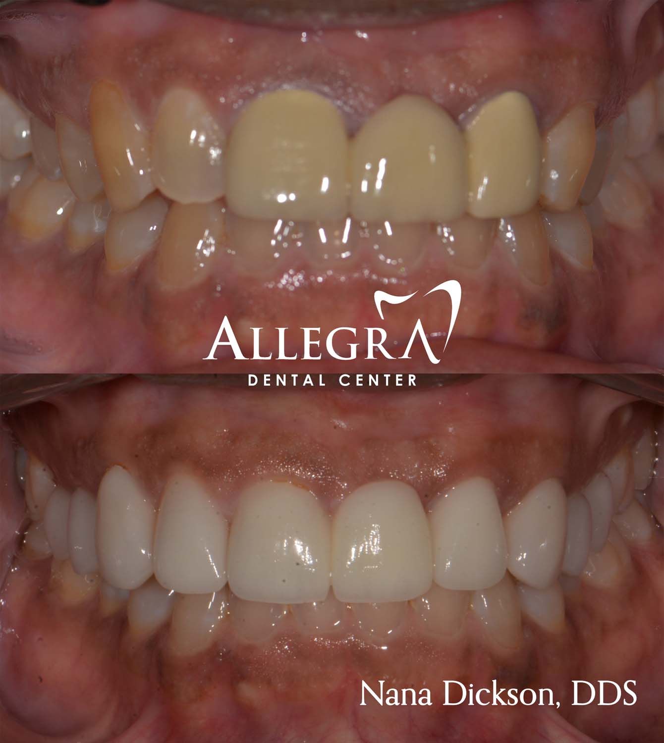 Veneers Before and After case 67 from Allegra Dental Center
